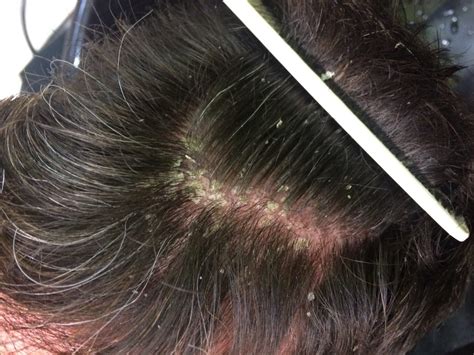 Flaky Scalp This Treatment Is A Revelation Figaro London