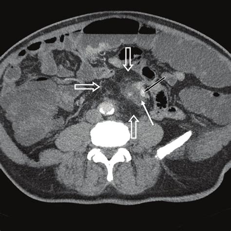 Abdominal Ct Scan In An Axial View After Intravenous Contrast Agents
