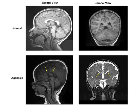 Mri Data For A Normal Subject Top And For A Subject With Partial