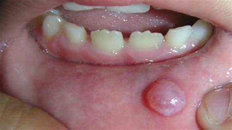 Mucocele Floor Of Mouth