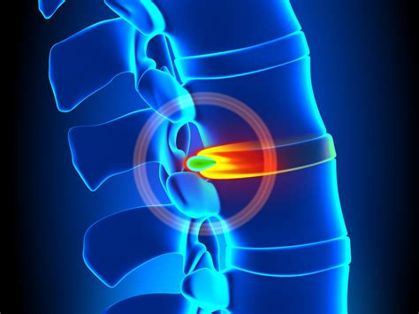 Understanding Spine Disc Pain Symptoms Stages And Treatments