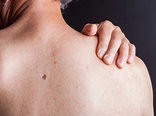 HIV Rash: What Does It Look Like and How Is It Treated?