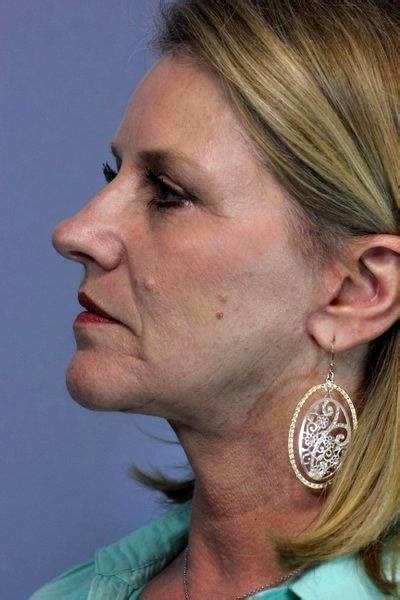 Before And After Lifestyle Lift 1 Facelift Info Prices Photos