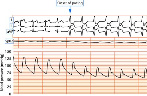 7 Pacemaker Syndrome Simultaneous Ecg And Femoral Arterial Blood