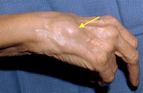 Dorsal Tenosynovitis Hand Surgery Source