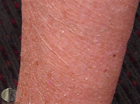 Feb 26, 2020 · graves' disease this is the most common cause of hyperthyroidism and has an autoimmune basis. alligator skin hypothyroidism - DocMuscles