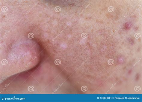 Lesions Skin Caused By Acne On The Face In The Clinic Stock Image