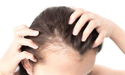 Hair Loss And Hormonal Imbalance In Women BeautyOnFleeck