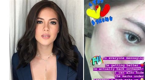 Shaina Magdayao Ibinahagi Ang Pinagdaanan Dahil Sa Naging ‘problema Sa Kanyang Mukha Push Ph