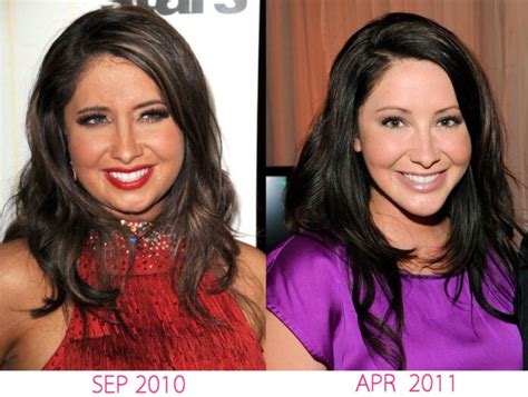 Bristol Palin Plastic Surgery With Before And After Photos