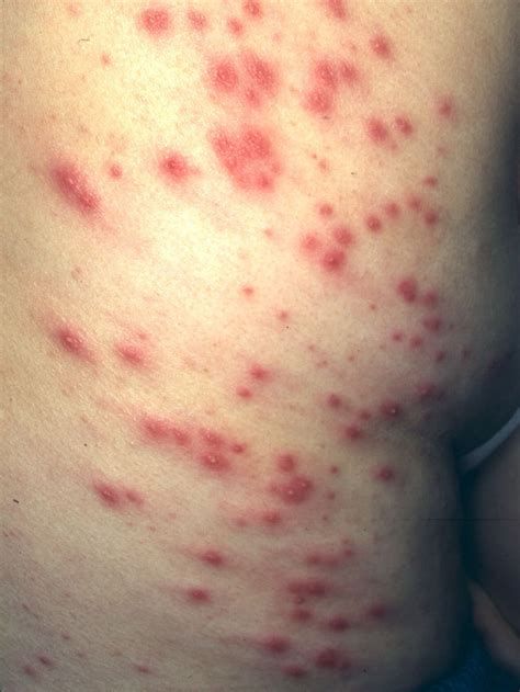 Folliculitis Furuncles And Carbuncles Skin Infections