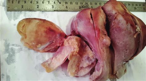 Gross Specimen Of Cut Open Uterus With Multiple Fibroids And Opened Up