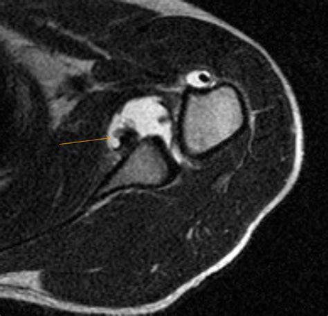 Recurrent Dislocation Shoulder Mri Radiology Imaging