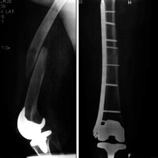 A Type Ii Distal Femur Fracture Treated By Minimally Invasive Plate My XXX Hot Girl