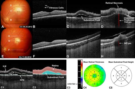 Subretinal Fluid Srf In Typical Active Ocular Toxoplasmosis As Seen