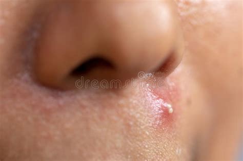 Lesions Skin Caused By Acne On The Face In The Clinic Stock Photo