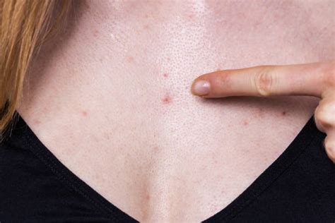 Acne Chest Stock Photos Pictures And Royalty Free Images Istock