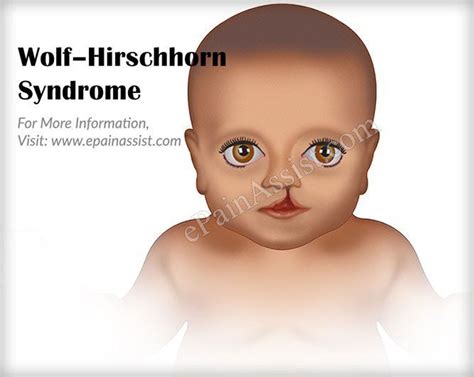 Wolf Hirschhorn Syndrome Causes Symptoms Treatment Prognosis Syndrome Genetic Disorders Wolf