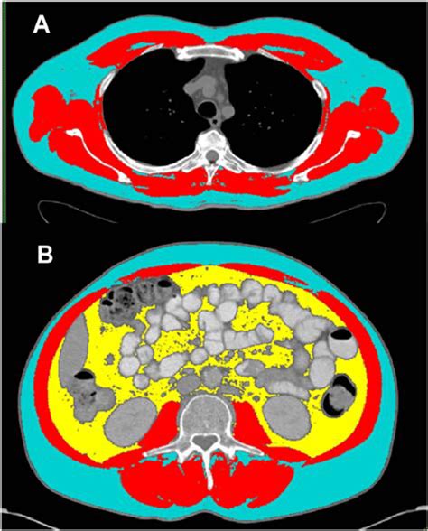 Example Thoracic T4 And Lumbar L3 Computed Tomography Scans With