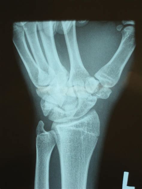 Trapezial Fracture Hand Orthobullets