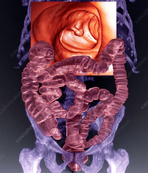 In the second example below, an em dash is more common than a colon, though the use of a colon is nevertheless correct. Intestines with colon polyp - Stock Image - M240/0709 ...