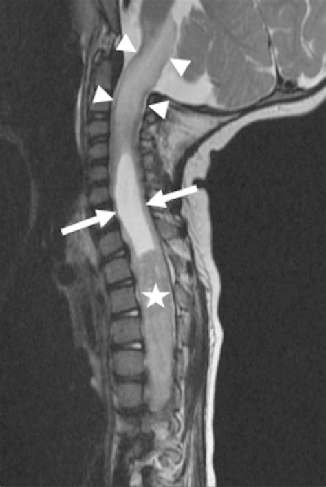 Mri Showing Spinal Cord Tumor In A Child Dr Prem Pillay