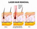 Quels sont les différents types de lasers ? - Epilia - 15 Centres d ...