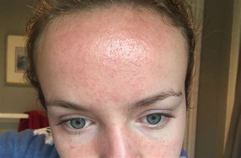 Big Rash On Forehead 15 Months After Accutane Finished Accutane
