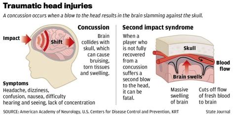 Concussion Diagram