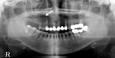 Panoramic Radiograph Showing A Defined Radiolucent Lesion In The Right