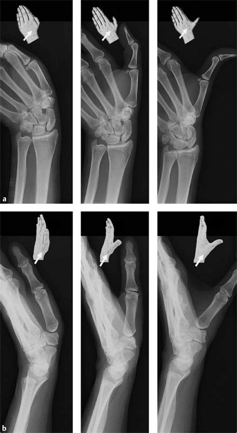 Intra Articular Fractures At The Base Of The First Metacarpal