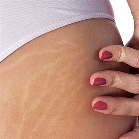 Ways To Combat Cellulite And Stretch Marks Mcaffeine