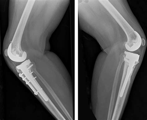 Total Knee Replacement With Rotational Proximal Tibial Osteotomy For