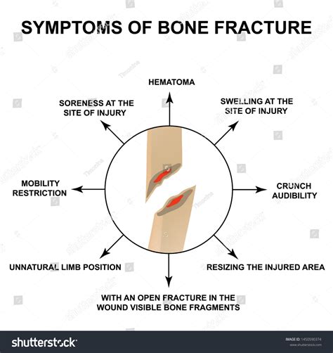 Symptoms Bone Fracture Bone Fracture Displacement 스톡 일러스트 1450590374