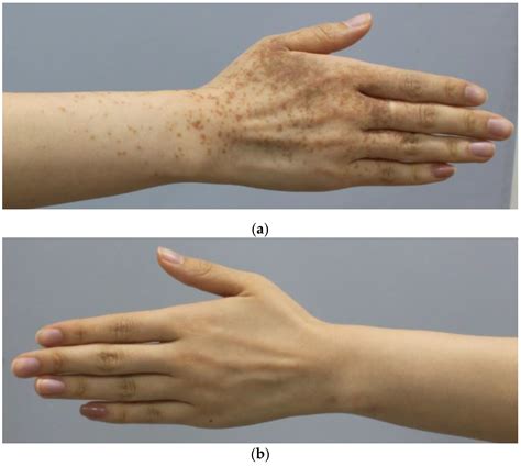 Dermato Free Full Text A Case Of Unilateral Hyperpigmentation
