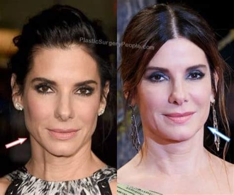 Did Sandra Bullock Have Plastic Surgery Before After