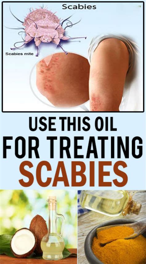 Use This Oil For Treating Scabies Scabies Health Health Tips