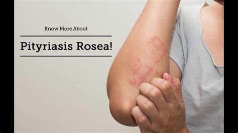 Fajarv P Rosea Skin Disease