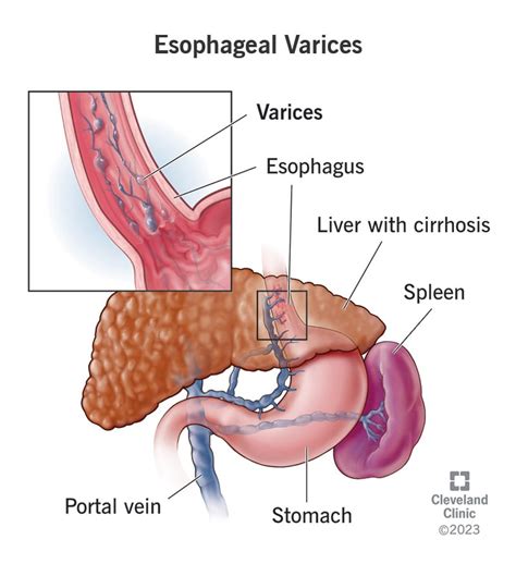 Portal Hypertension And Bleeding Esophageal Varices Their Occurrence