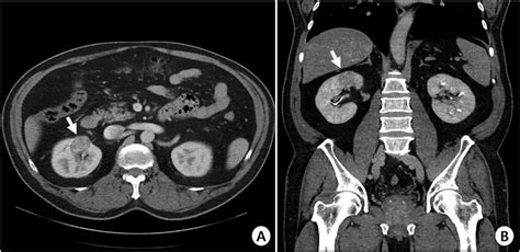 Preoperative Kidney Dynamic Computed Tomography Scan A Axial View B