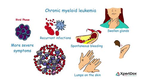 What Is Chronic Myeloid Leukemia Youtube