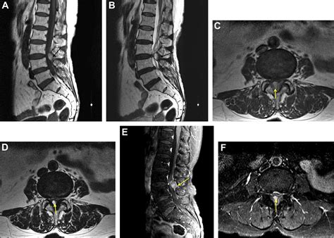 Ligamentum flavum consists of collagen fiber namely of elastin. Epidural block-induced ligamentum flavum hematoma ...