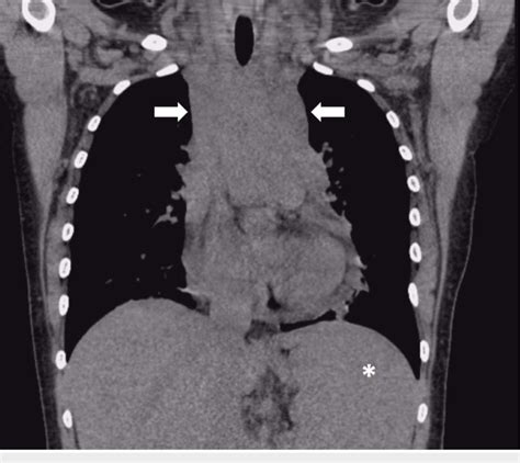Non Contrast Computed Tomography With Coronal View Demonstrating A