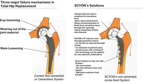 Scyon Orthopaedics Hip Replacement Surgery Implants