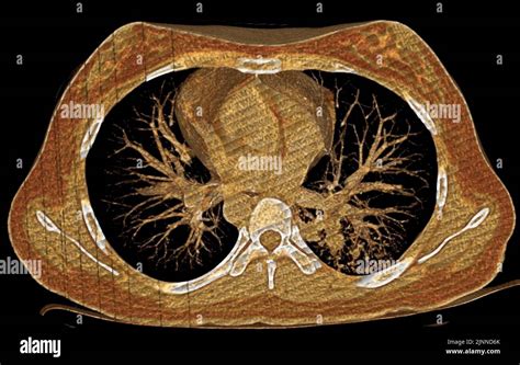 Normal Lung Ct Scan Stock Photo Alamy