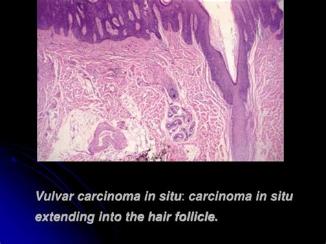 Ppt Pre Cancer And Malignant Disease Of Vulva Powerpoint Presentation