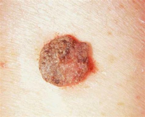 Seborrheic Keratosis Pictures Symptoms Treatment Removal And Causes