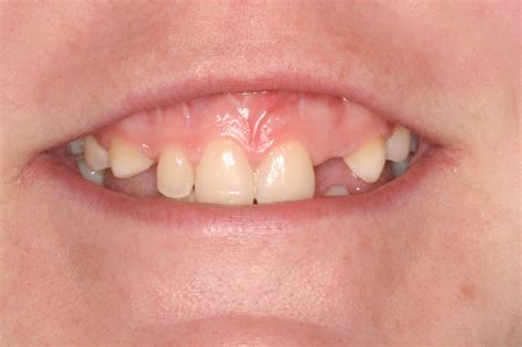 Clinical Tips Smile Line Assessment Irish Dentistry