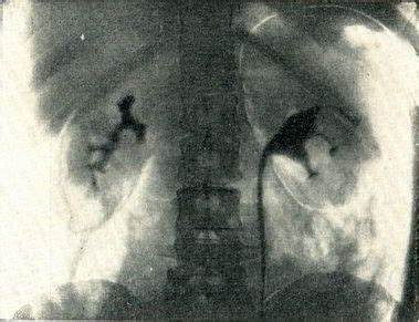 Диеты при опухоли почки