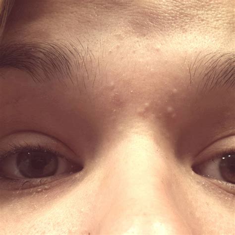 I Have These Bumps Between My Eyebrows I Cant Make Them Go Away Any